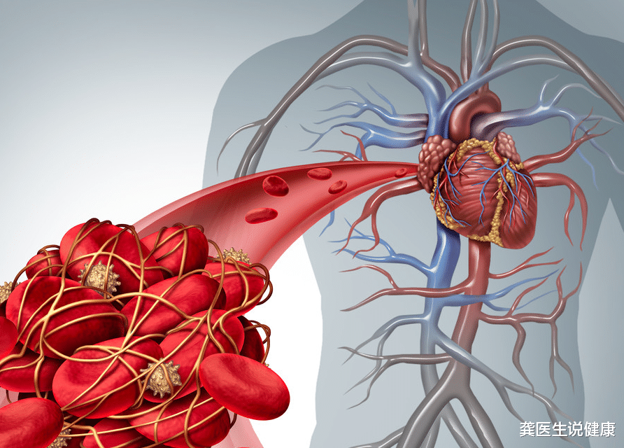 龚医生说健康 血栓的形成非朝夕,避免生活中的“2怕和3忌”,血管或可通透无阻