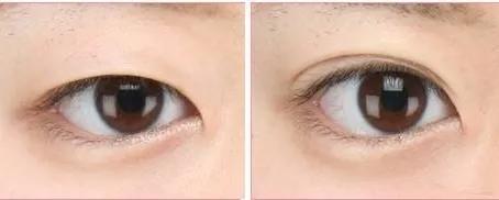 小美说美|妈生双眼皮怎么做