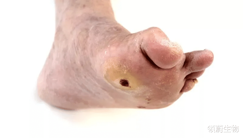 领蔚生物|研究综述：干细胞疗法对糖尿病相关病变的临床试验