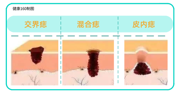 160健康研究所|身体出现这样的痣，可能是癌细胞“在试探”，快看你有没有