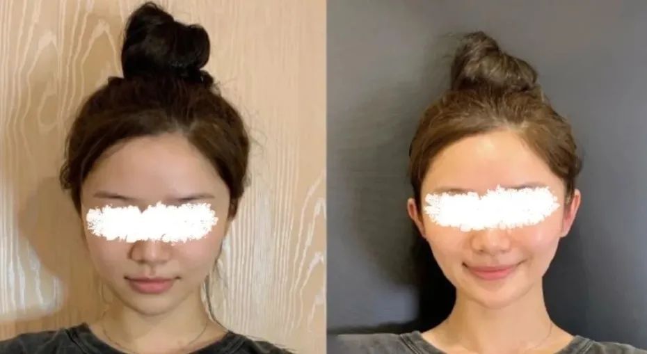 汉方医读 为了变美，真的有人愿意让自己永久残疾。细数那些“畸形”的医美项目。