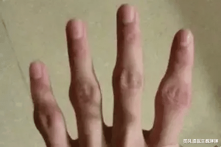 腸胃|類風濕手指關節長疙瘩是為什么？與類風濕結節相混淆的結節有哪些？