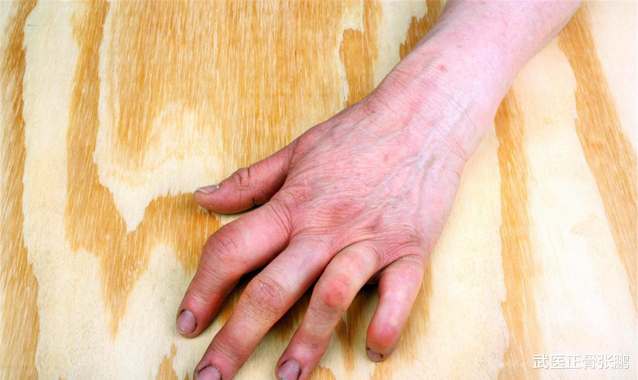 尿酸|午餐一碗面条，25岁小伙肾衰离世，医生：或是肾衰的“催化剂”尽早仍