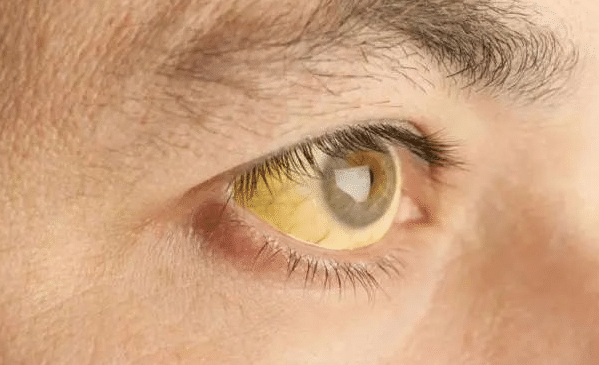 金兰中医学社|肝病“天敌”找到了，并非榴莲，平时敞开吃，肝毒慢慢排出，肝脏白净如初