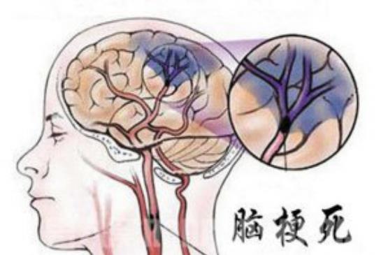 午美聊健康体态 为何农村因脑梗死的人越来越多?医生坦言:与3大因素有关