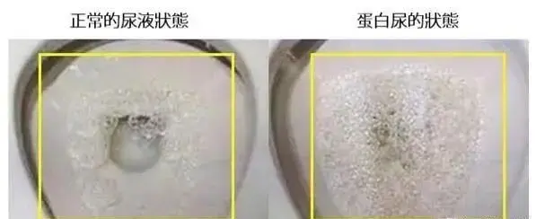 麦吉科普|尿有泡沫，是不是肾不健康了？出现这4种情况时，可能真是肾病