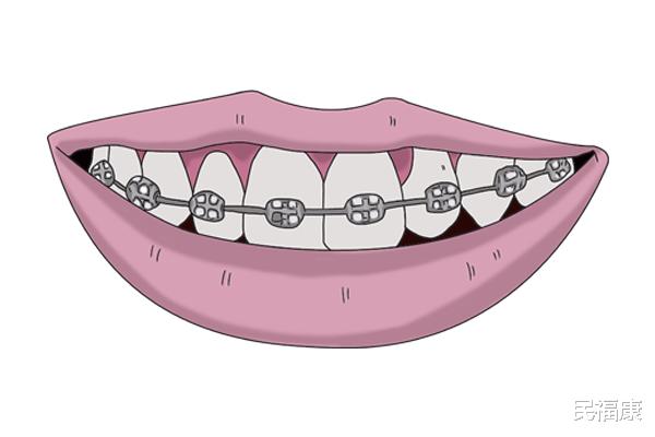 洁牙|洗牙好不好？浅谈洗牙的利与弊，多久洗一次合适？
