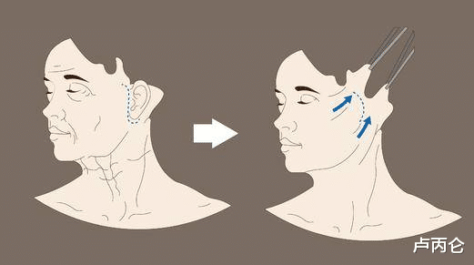医生|做完拉皮之后效果不错，但是一两周之后就没效果了是怎么回事？