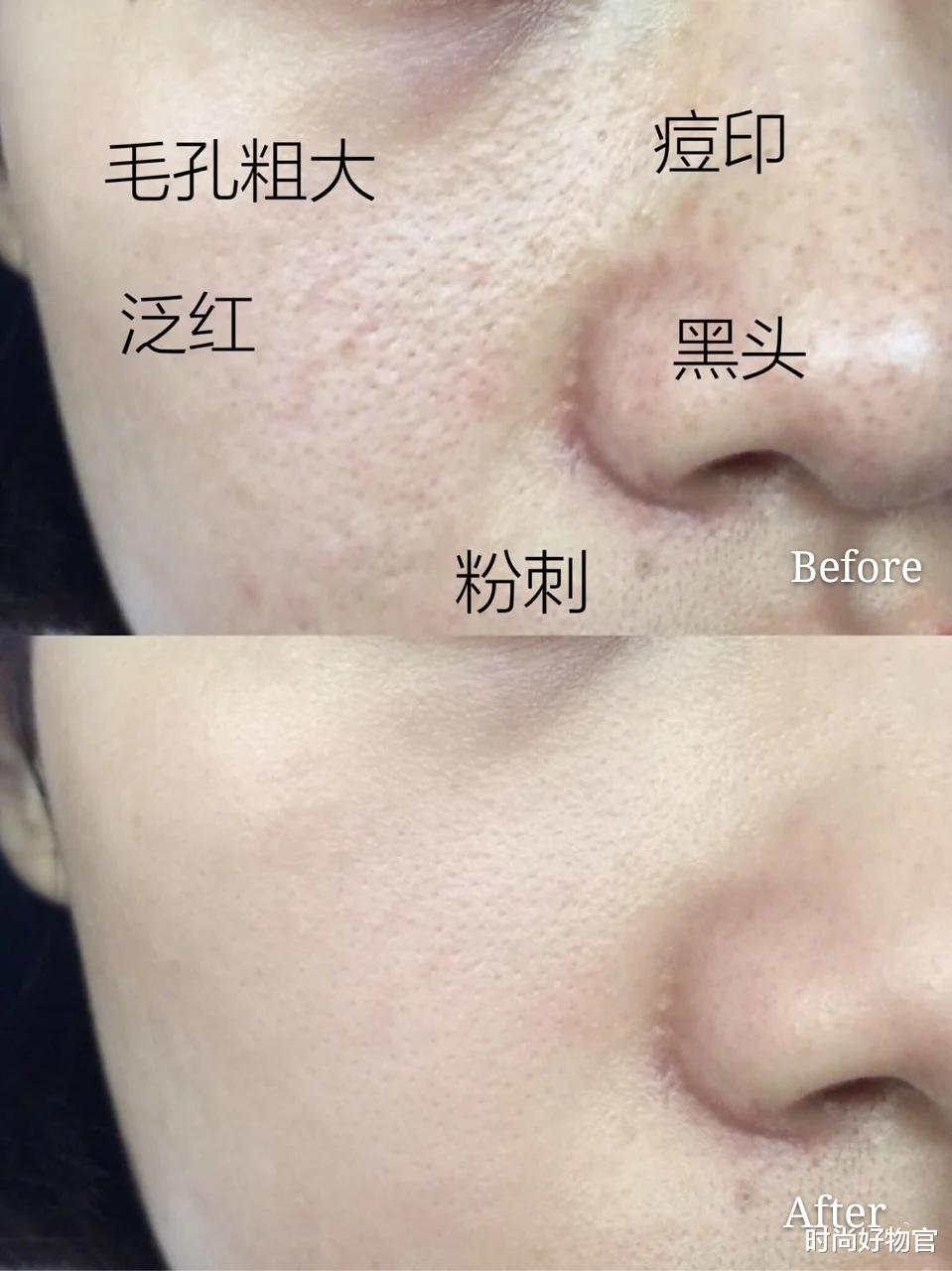 时尚好物官|为变美打“美容针”真的值得么？过来人说出心里话，得不偿失