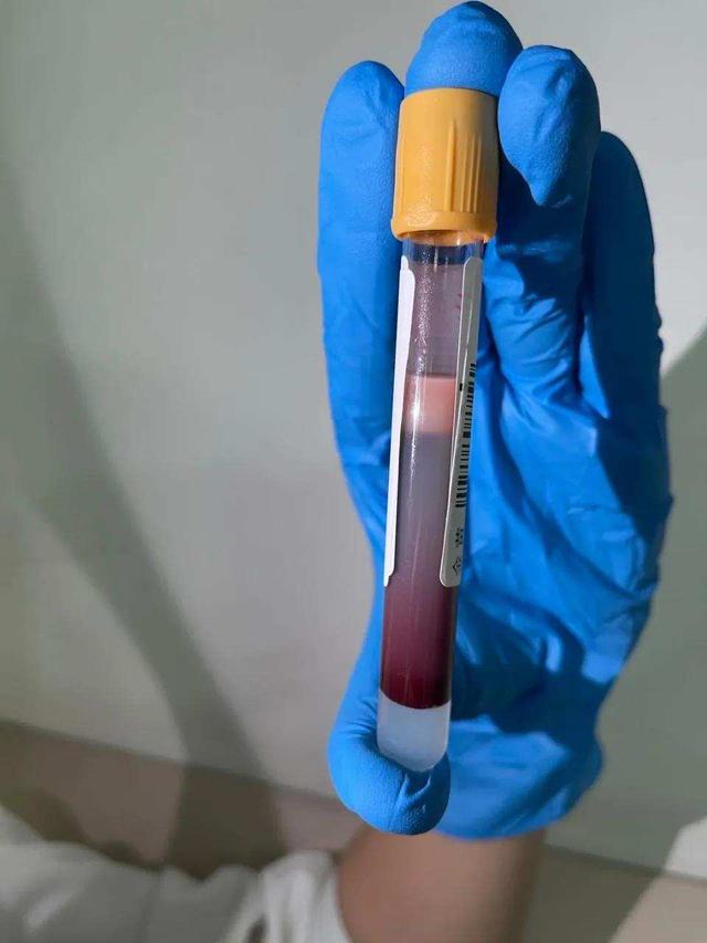 医生|24岁小伙抽血检查，半管都是油！医生都感叹没见过