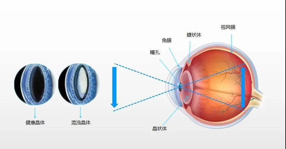 白内障|快让爸妈别信这3个谣言,分分钟可能夺走他们的视力!