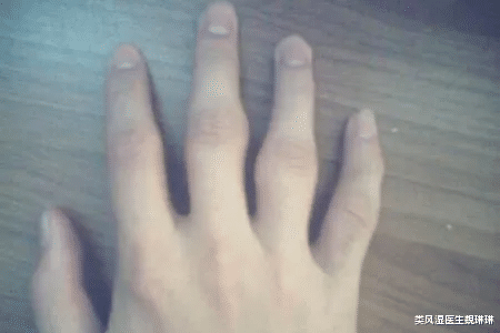 腸胃|類風濕手指關節長疙瘩是為什么？與類風濕結節相混淆的結節有哪些？