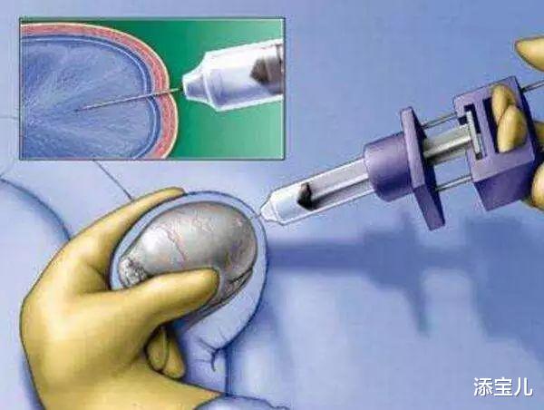 添宝儿|通过穿刺取出的精子做试管婴儿是否安全?