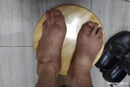 痛风科朱红梅主任 痛风患者快醒醒吧，不能再放任自己胖下去了！