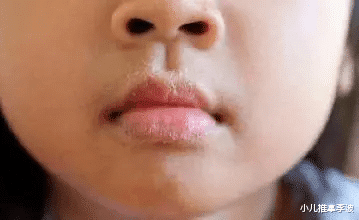 小儿推拿李波|小儿推拿李波:宝宝嘴唇干燥脱皮怎么办?小儿推拿及食疗调理方法