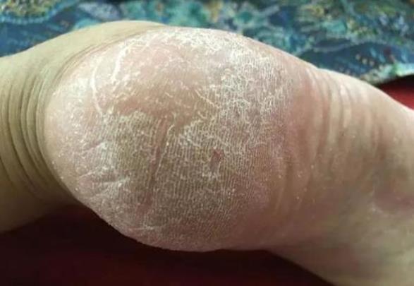 袜子|为什么脚后跟经常开裂？除了缺乏维生素，还可能是健康在向你求救！