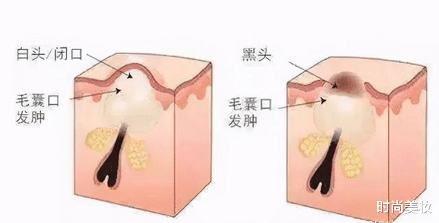 宋轶|宋轶用纯露敷脸2年，皮肤自带磨皮滤镜，网友：黑头、闭口的救星