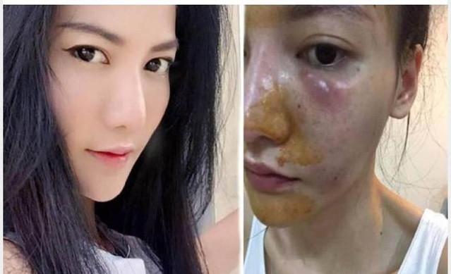 好物官|泰国女子连打6年美白针，如今已“烂脸”，其实美白不用这么麻烦