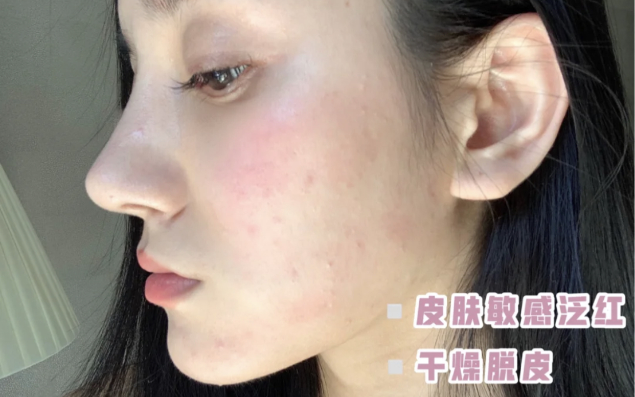 蒂尔施|女生皮肤“秋敏”5大特征,别傻乎乎当成闭口,难怪肌肤越来越糟