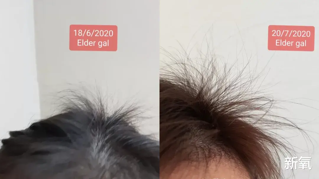 脱发|要是早知道这几招,最起码少掉几万根头发,心痛…