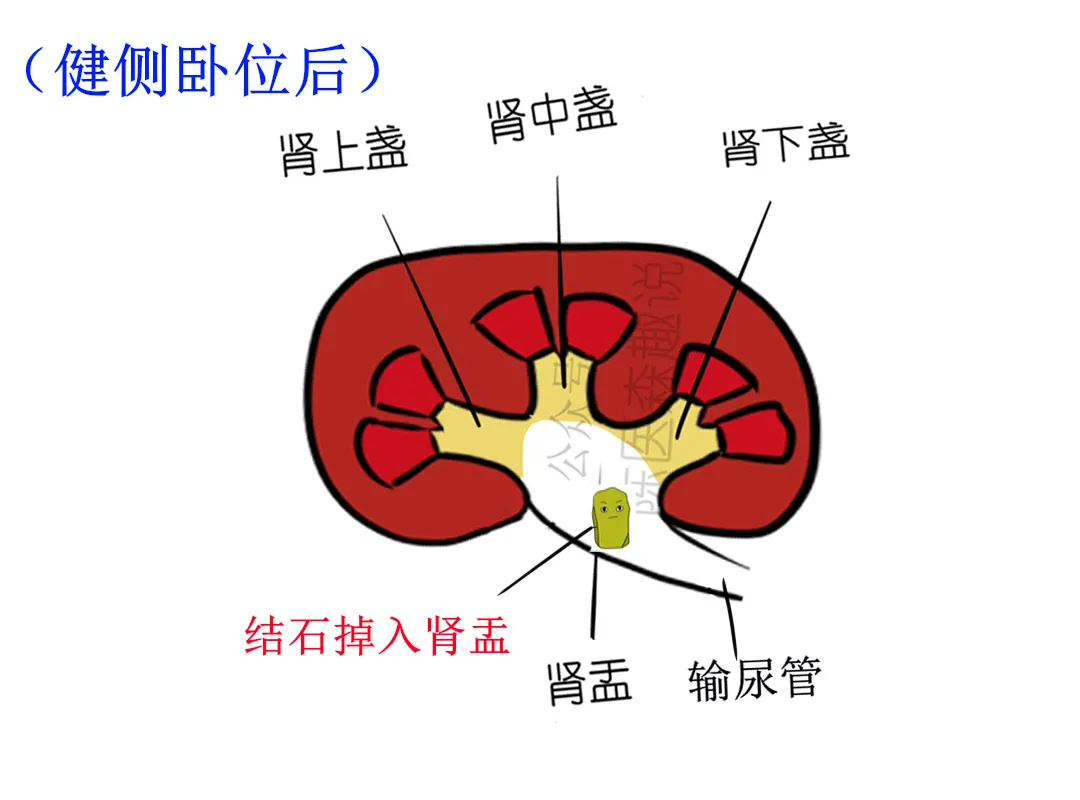 陈医森趣说|肾下盏的结石很难排出？一定要试试这个方法