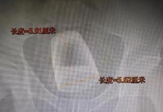 医生|玻璃杯、弹球？你永远想不到，医生会从病人肛门里取出什么东西