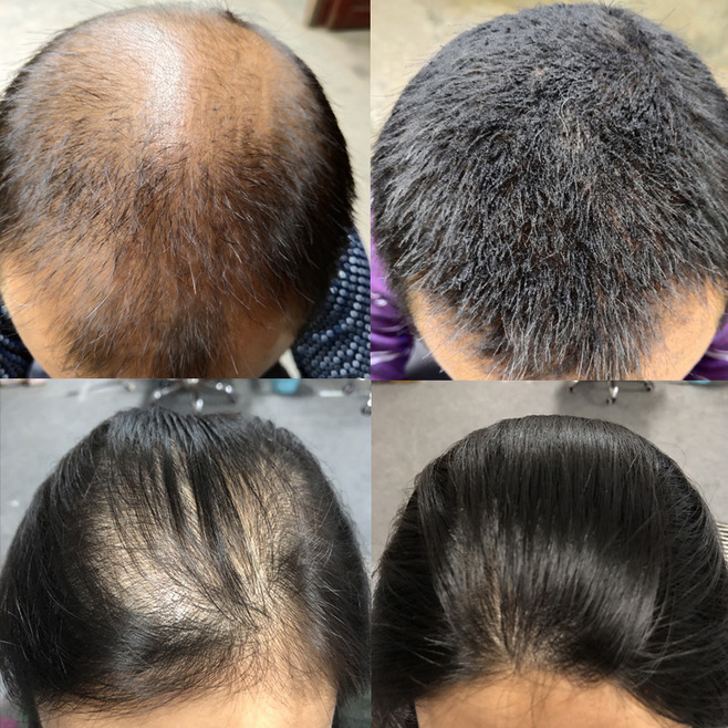 张医生科普|为什么越来越多的年轻人开始脱发、秃头？医生：有可能患上这3种疾病