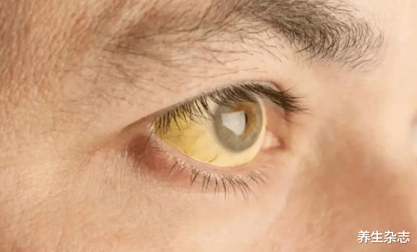 口腔健康|母女二人频繁腹泻，双双查出肝癌，医生：常吃1种菌类，等于“自残”