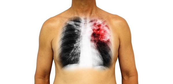 医说健康|肺癌人数居高不下？医生告诫：这4个“诱因”，很多人都忽视了