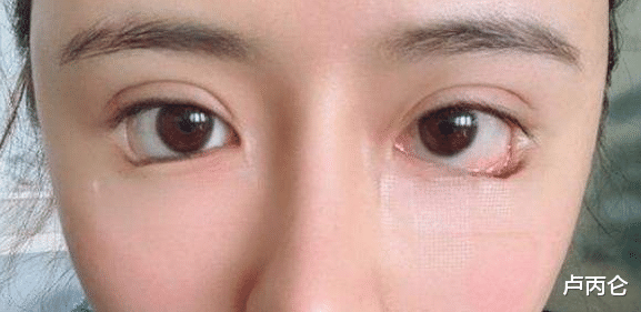 |眼睛太小了怎么变大？