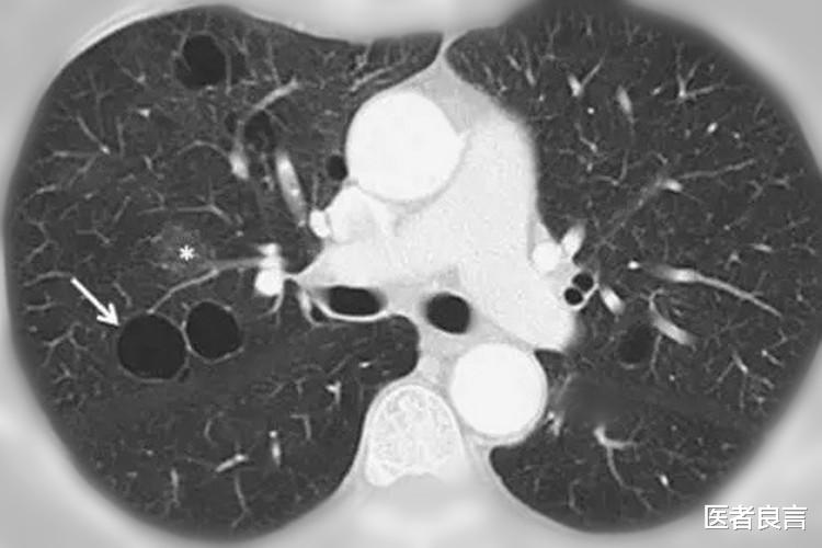 医者良言 什么是肺大疱?被查出肺大疱应该怎么办?医生告诉您答案