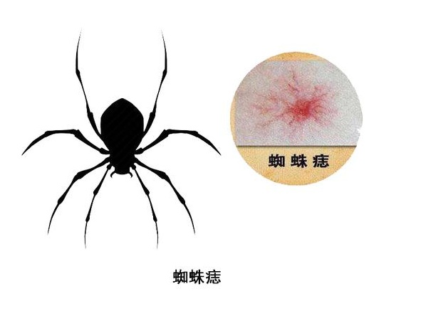 漫说健康 肝硬化早期有征兆！手掌出现这个异常，暗示你肝脏生病了