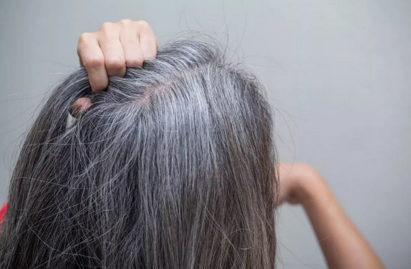 脱发|女人缺铁贫血会面色萎黄,还脱发?教你2招,可“去黄防脱”