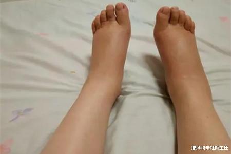 痛风|寒潮来袭，痛风患者冬季保健七大重点需牢记！