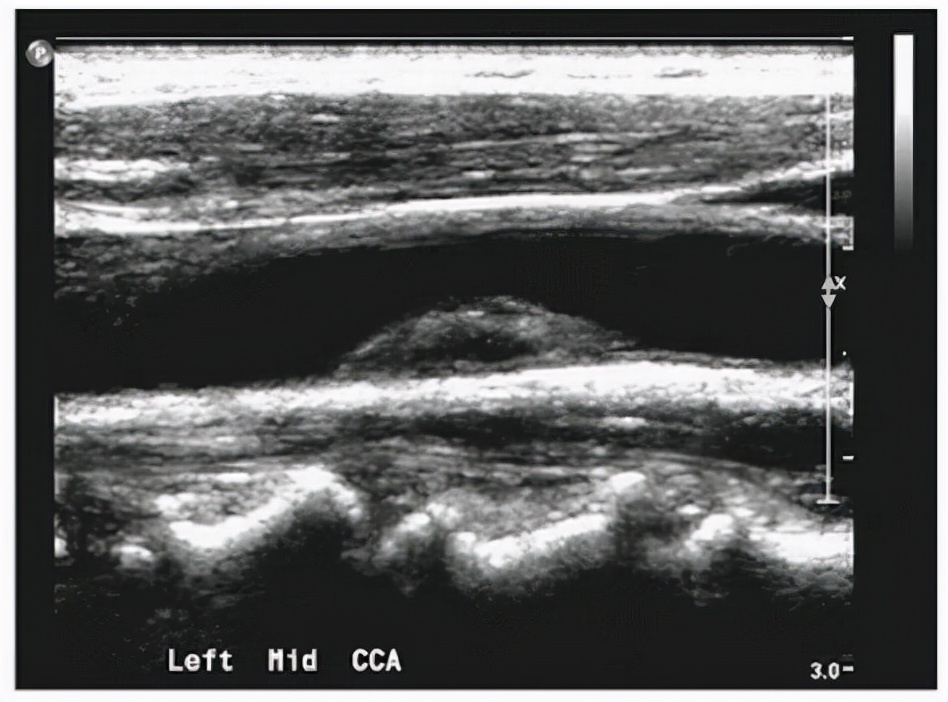 口腔溃疡|血脂升高，大爷忙问怎么办？医生却说是好事，这样解释能满意吗？