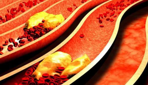 水果|“高血脂”的真正起因是什么?并非是肥肉,这种“酸”要尽量少吃