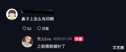 整容|兜儿产后素颜出镜，鼻子上有疤被质疑整容，否认称：之前摔跤缝针