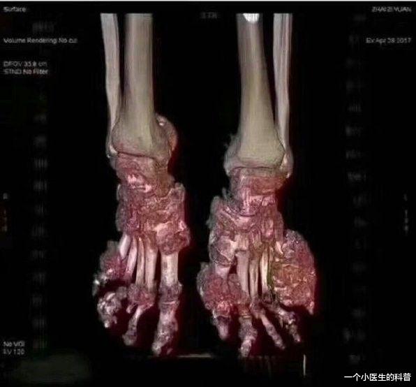 大蒜|16岁的小男孩尿酸高于600，被确诊为痛风，这都是因为每天喝果汁