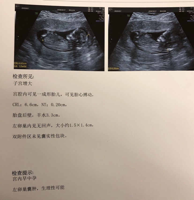 怀孕妈妈知识宝典|nt图有三条线是怎么回事，和男女有关吗？