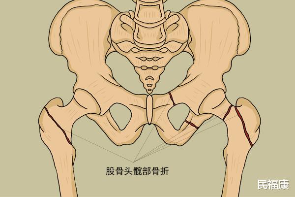 消化不良|一摔倒就骨折，怎么回事？50岁后，3种营养要舍得补，强身健骨