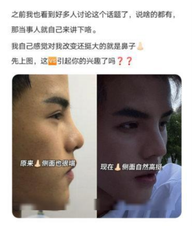 迪丽热巴|殷世航自曝整容，看清未整前的照片后：幸亏整的早