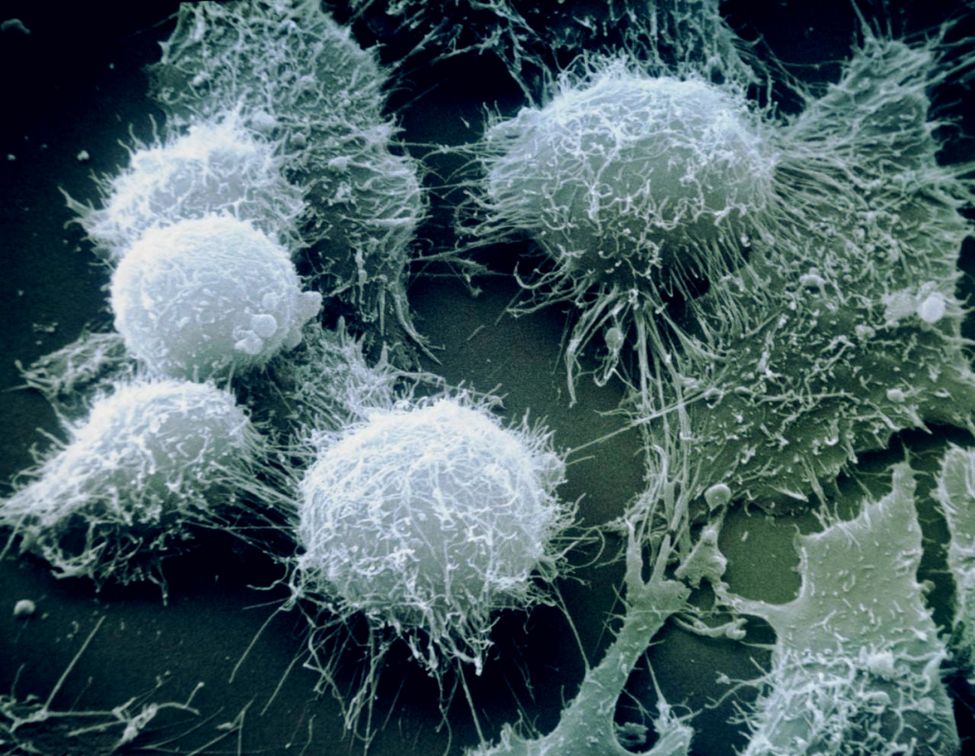 科学家 把癌细胞注射进健康人体内，会不会得癌症？科学家做了大胆的实验