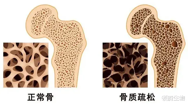 中国9000万人患有骨质疏松，干细胞通过分化为成骨细胞可改善患者症状