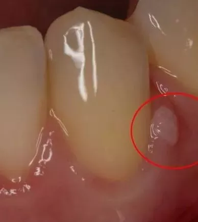 維生素A|牙齦上長膿包，擠掉后還反復長出，怎么回事？