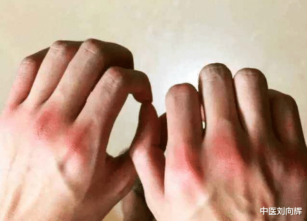 附子|关节红、肿、痛？简单4味中药，从骨节里改善你的风、寒、湿。