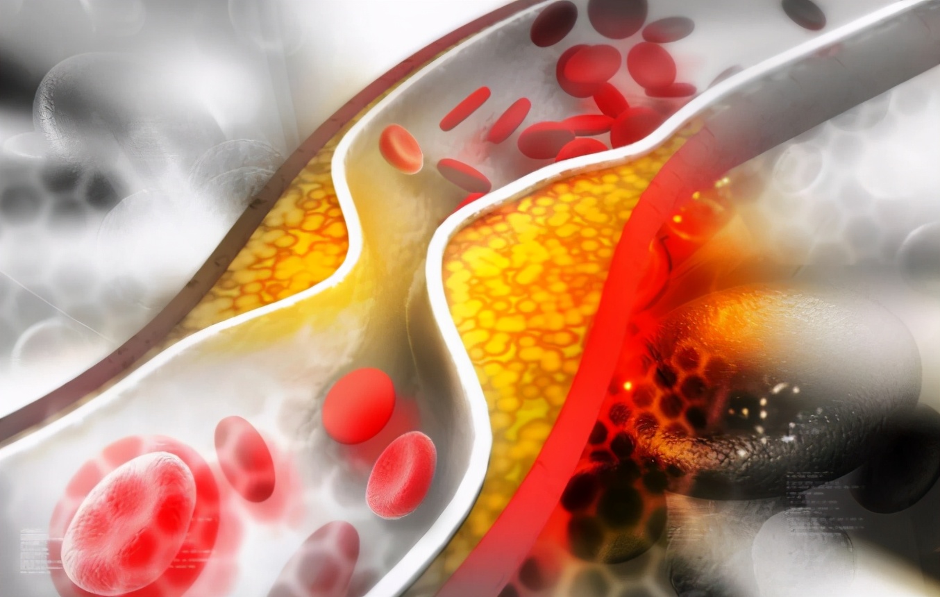 胆固醇|胆固醇高不能吃鸡蛋?91岁内科教授:不想胆固醇升高,要远离2物