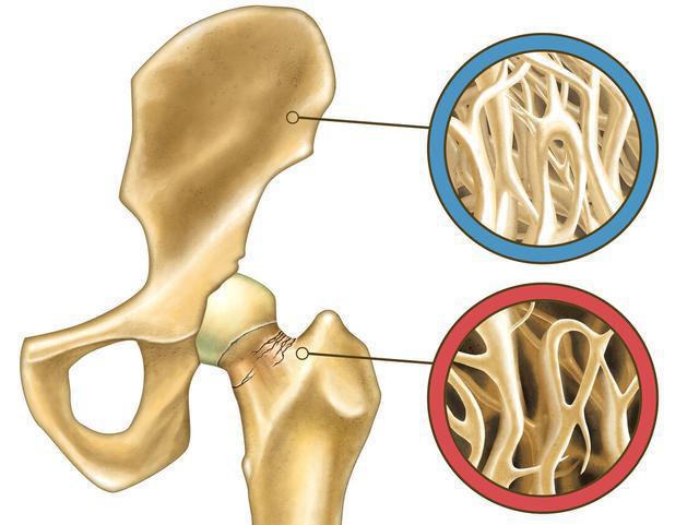 坚果|1种“坚果”或是骨质疏松“帮凶”，比烟酒还毁骨骼，抓紧戒掉