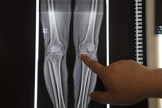 海绵宝宝爱养生|大多数老年人经常感到膝关节疼痛，是怎么回事？如何进行防治？