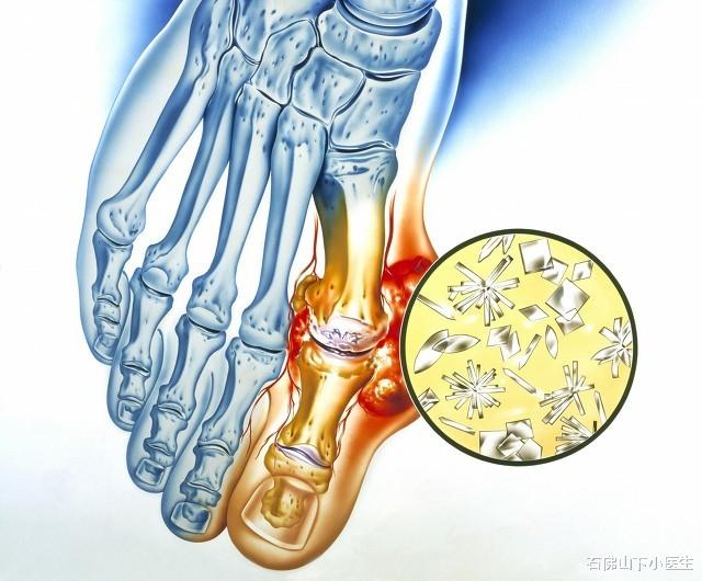 石佛山下小医生|痛风患者，建议不要喝啤酒和白酒，实在忍不住，可以少量喝点葡萄酒