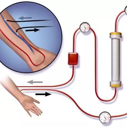 尿毒症|尿毒症后，必须要考虑的腹透VS血透，哪个更好？文末有必读内容~